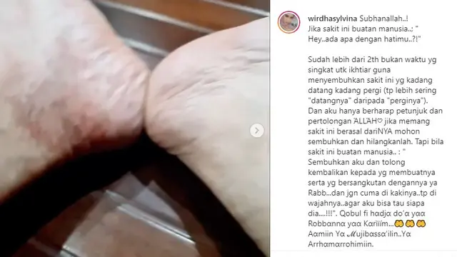 Unggahan Neng Wirdha tentang penyakit kakinya (https://www.instagram.com/p/CQzonI7nvFe/)