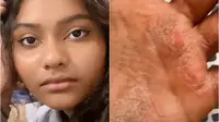 Perempuan berusia 17 tahu menderita psoriasis dan kondisinya makin parah usai pakai hand sanitizer  (dok.TikTok/mmoonsey/https://www.tiktok.com/@mmoonsey/video/7027526040574577921/Komarudin)