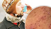 Menjaga stamina atau imun tubuh, berkemungkinan besar terjauh dari virus herpes bagi penderita asma.