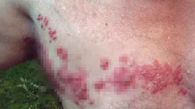 herpes genital