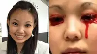 Darah Sering Mengucur dari Mata dan Lidah Wanita Cantik Ini 