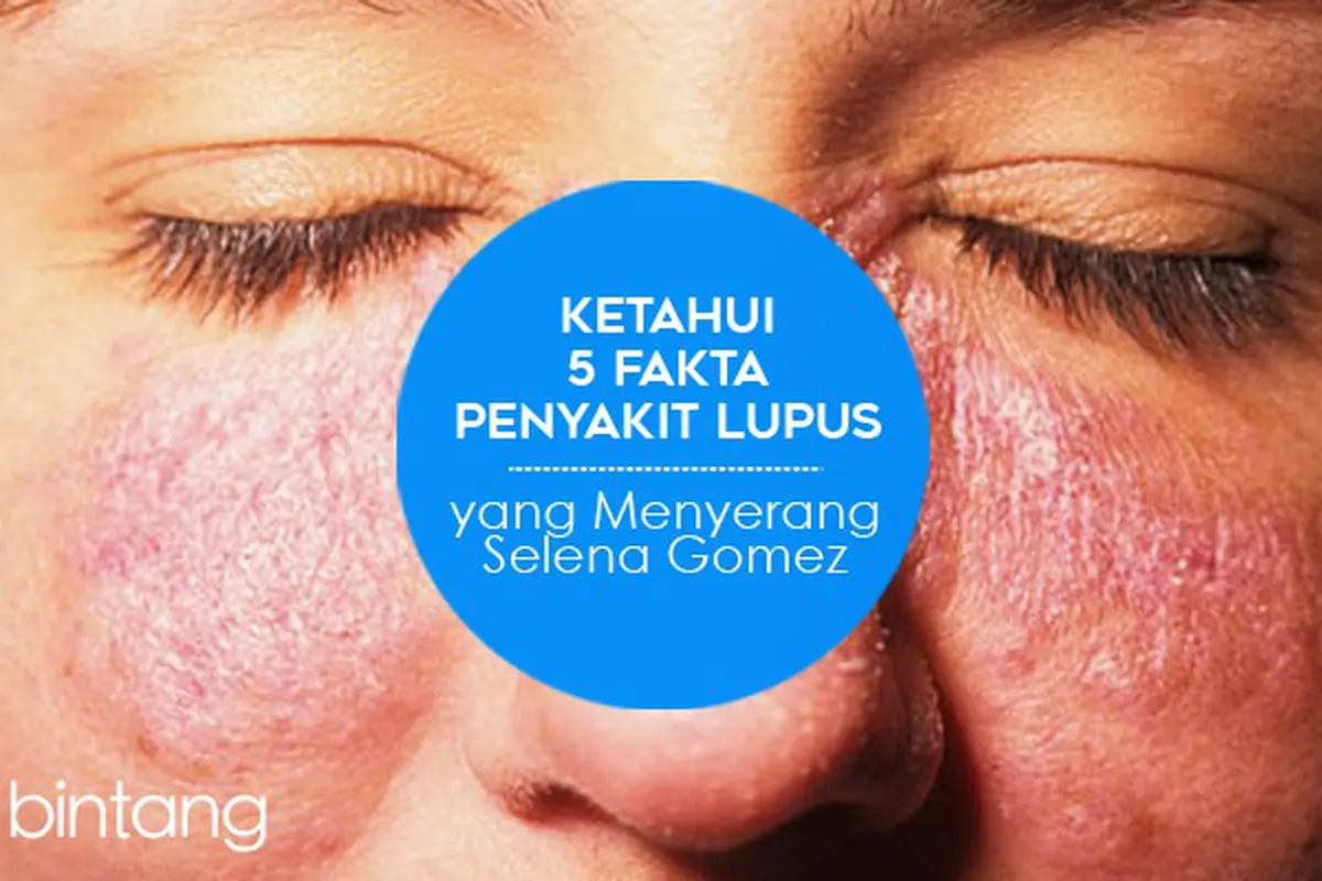 [Bintang] Ketahui 5 Fakta Penyakit Lupus yang Menyerang Selena Gomez