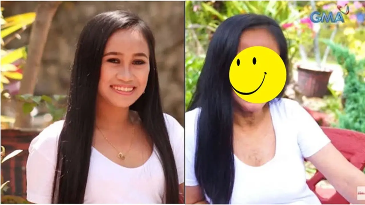 Idap Penyakit Langka, Wajah Gadis 16 Tahun Ini Terlihat Seperti Nenek