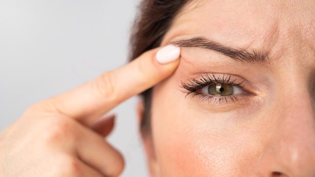 Jerawat di Kelopak Mata, Ketahui Penyebab dan Cara Mengatasinya