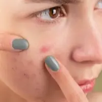 Ternyata beberapa kebiasaan ini dapat menimbulkan atau memperburuk kondisi kulit berjerawat, loh!/copyright pexels/Anna Nekrashevich