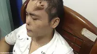 Hidung Pria di China Tumbuh di Dahi