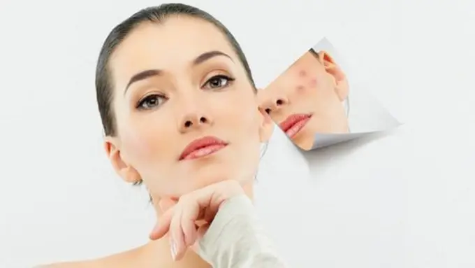 Jerawat memang bikin semua orang gak pede/copyright:thinkstockphotos.com