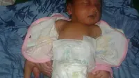 Bayi Jihan Novitasari hingga kini masih menunggu jadwal operasi yang entah kapan dilakukan tim medis RSUP dr Kariadi. (foto: Liputan6.com / edhie prayitno ige)