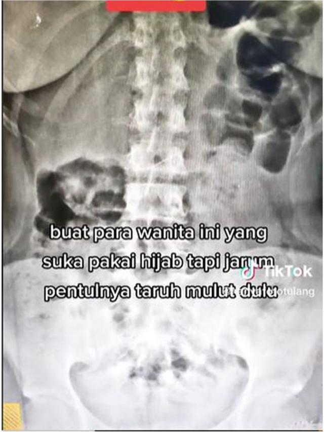Tertancap di Usus, Wanita Ini Tak Sengaja Telan Jarum Pentul saat Pakai Hijab