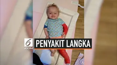 Seorang anak berusia 2 tahun mengidap penyakit langka Osteogenesis Imperfecta (OI) atau yang dikenal penyakit tulang rapuh. Kondisi itu dialaminya sejak berusia 3 bulan.