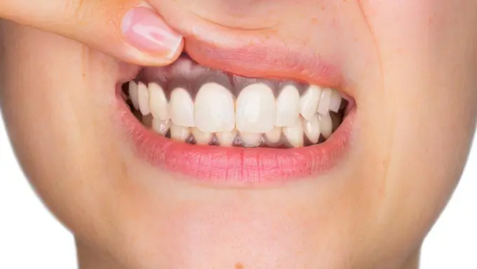 Inilah 3 Penyebab Gusi Hitam yang Anda Perlu Tahu (Stefano Garau/Shutterstock)