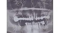 Viral Diduga Susuk, Foto X-Ray Wajah Pasien Ini Dipenuhi Seperti Isi Staples