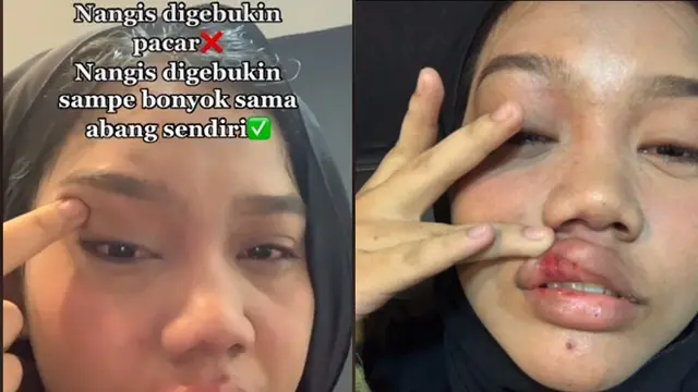 Dipukul Kakaknya Sampai Babak Belur, Kondisi Wanita Ini Bikin Pilu