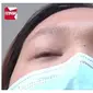 Gagal Operasi Plastik, Kelopak Mata Wanita Ini Tak Bisa Tertutup Selama Setahun (Sumber: Oddity Central)