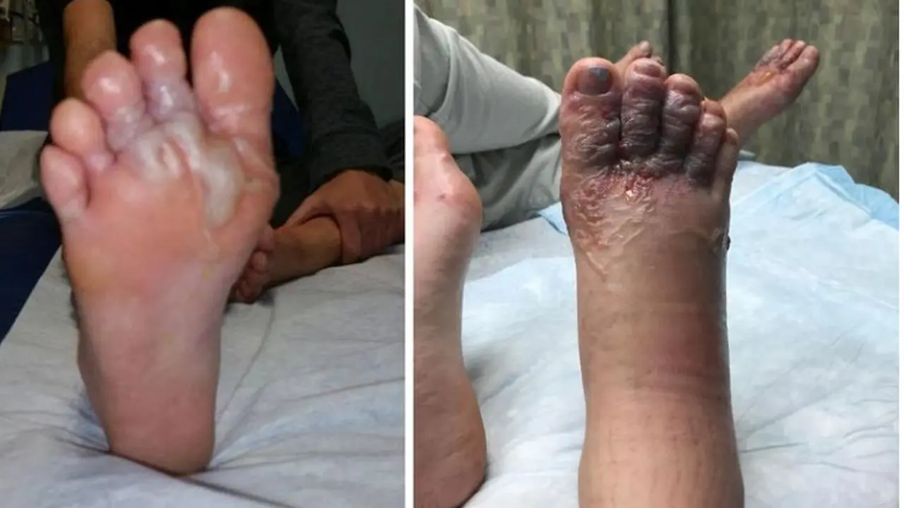 Habis Main Pasir di Pantai, Pasangan Ini Alami Penyakit Mengerikan