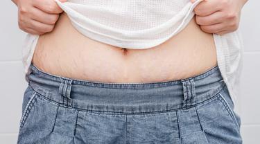 Jangan Biarkan Bahagiamu Pasca Melahirkan Terusik Oleh Stretch Mark Beauty Fimela Com