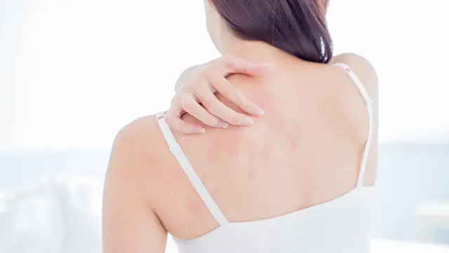 Apakah Perawatan Wajah Boleh Dilakukan oleh Penderita Eksim? Kenali Dulu Kondisi Kulitmu, Yuk!