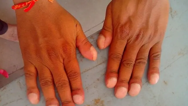 Telinga Kusut hingga Kuku Gepeng, 6 Tanda Tak Biasa Penyakit Jantung