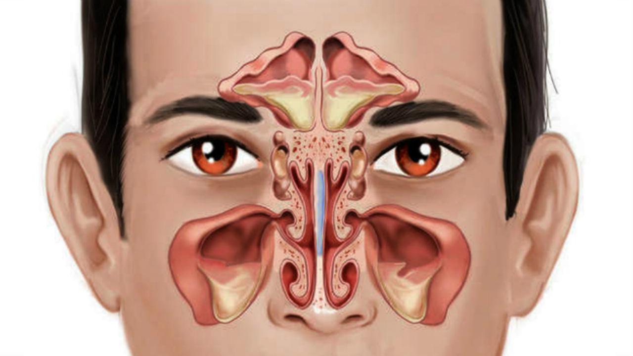 Sinusitis