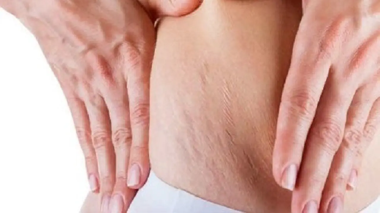 stretch mark