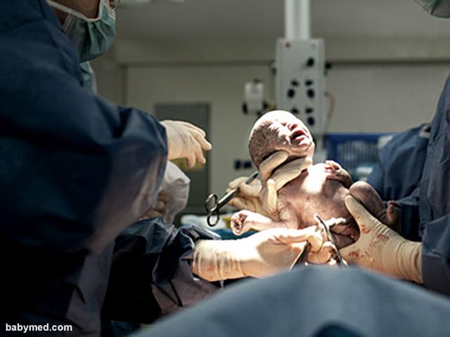 Perhatikan 5 Hal Ini Saat Operasi Caesar Pakai Bpjs Kesehatan Bisnis Liputan6 Com