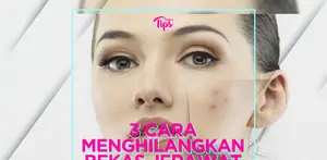 3 Cara Menghilangkan Bekas Jerawat Membandel