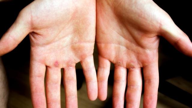 Penyebab Kapalan dan Cara Mengatasinya