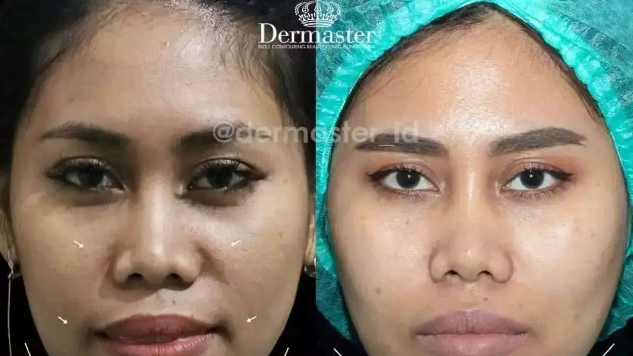 Potret Evi Masamba sebelum dan sesudah tanam benang (Sumber: Instagram/dermaster_id)