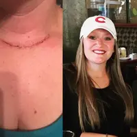 Emily Link mengidap kanker tiroid selama 5 tahun | Sumber Foto: Emily Link/Women's Health Magazine