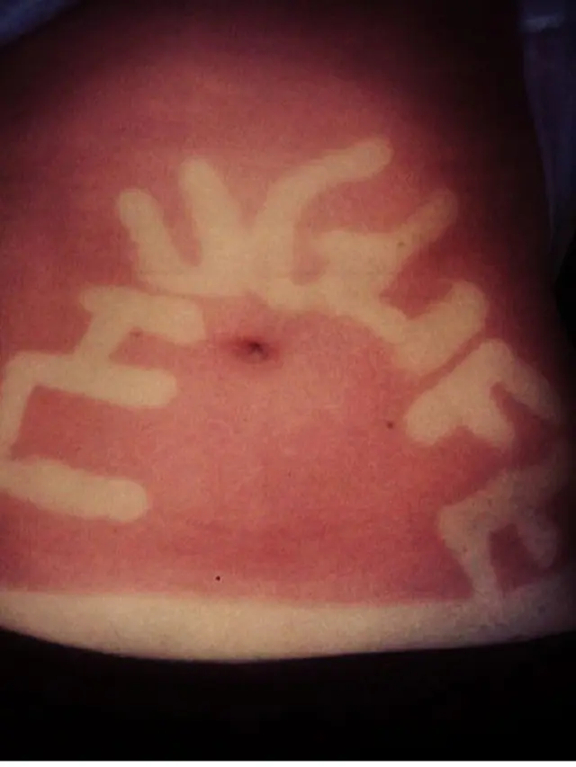 Sunburn Tattoo/Art