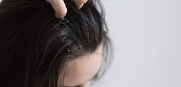 penggunaan produk rambut yang tidak cocok juga bisa menjadi pemicu ketombe. /copyriht freepik