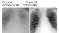 Dua foto ronsen pasien COVID-19 berusia lansia yang sudah vaksinasi COVID-19 dan satunya lagi belum atau tidak menerima suntikan vaksin Corona (Foto: Faheem Younus/https://twitter.com/FaheemYounus/status/1443556463537016836)