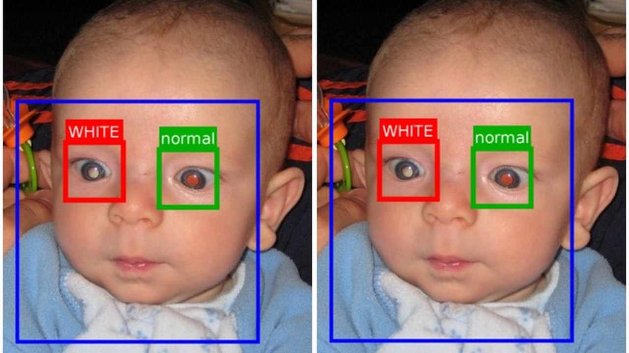 Aplikasi Pendeteksi Sakit Mata Pada Anak