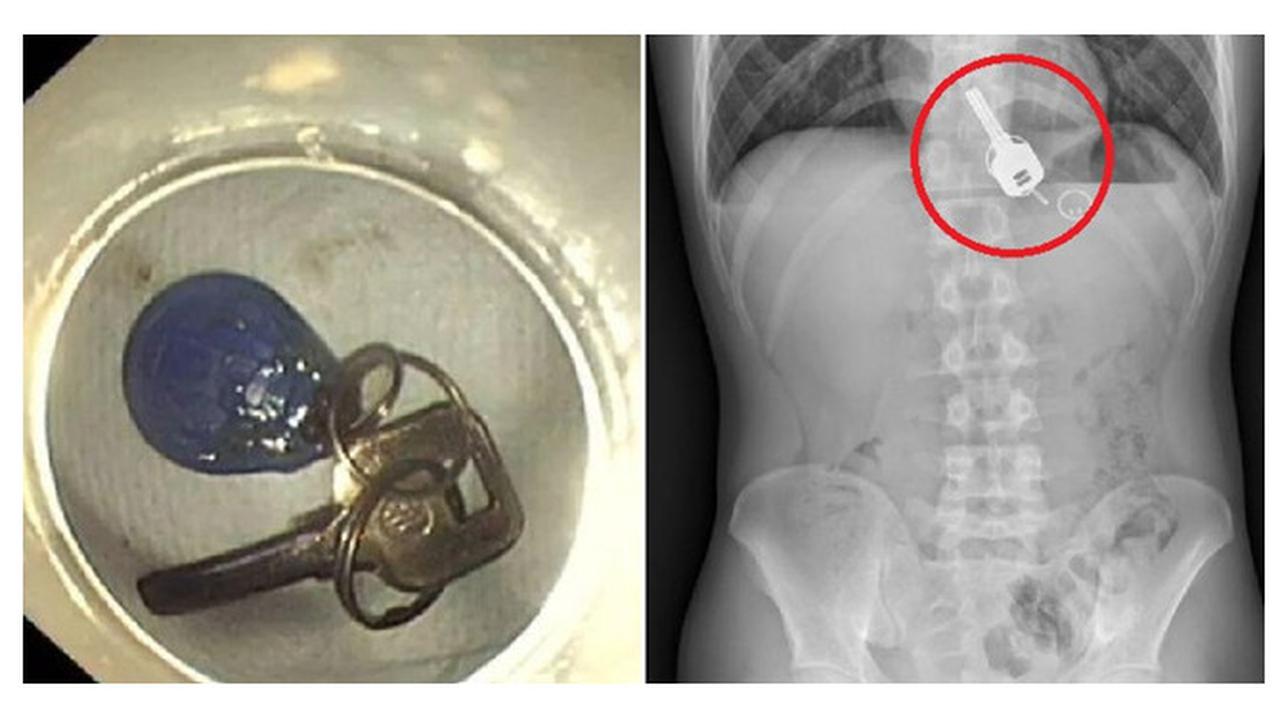 Akibat Mabuk Berat, Pria Ini Tak Sadar Telan Kunci Rumah