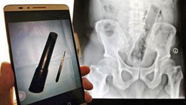 Hasil city scan yang dilakukan dokter terhadap pria | Photo: Copyright dailymail.co.uk