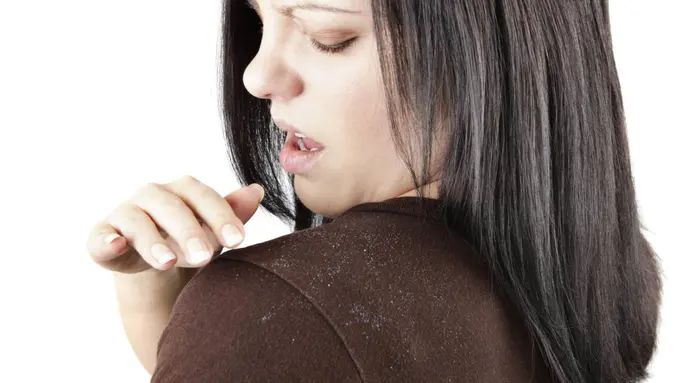 Tips Mudah Menghilangkan Ketombe