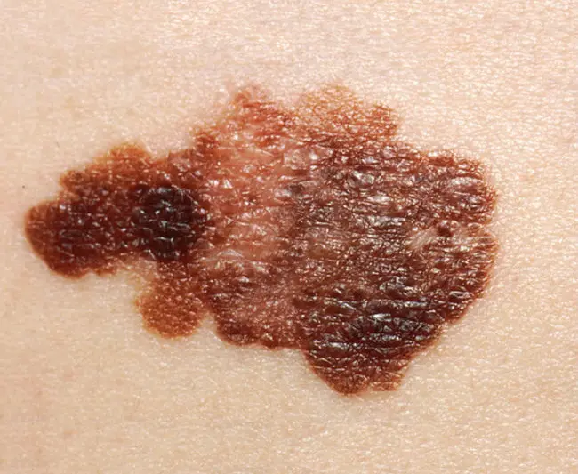 Tak ada batasan yang jelas pada munculnya tanda di kulit. Source: cancer.gov