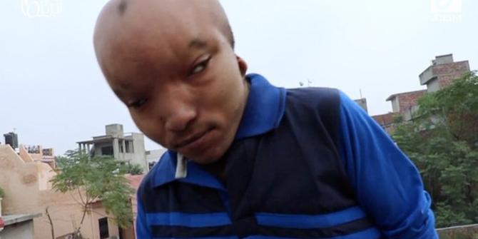VIDEO: Pria Ini Dijuluki Alien Karena Miliki Kepala Besar