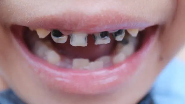 Kenali Penyebab Gigi Keropos pada Bayi dan Balita serta Cara Mengatasinya