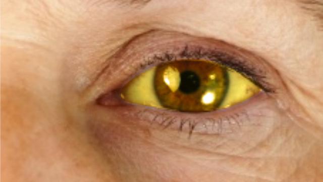 Mata Kuning? Waspadalah Gejala Penyakit Berikut Ini!