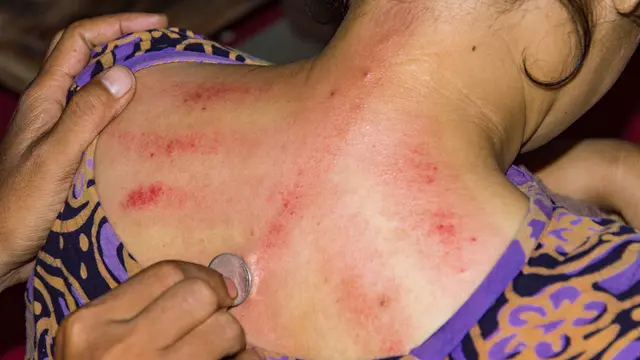 Dipercaya Redakan Sakit Kepala, Ternyata Kerokan Berbahaya Bagi Kesehatan Tubuh