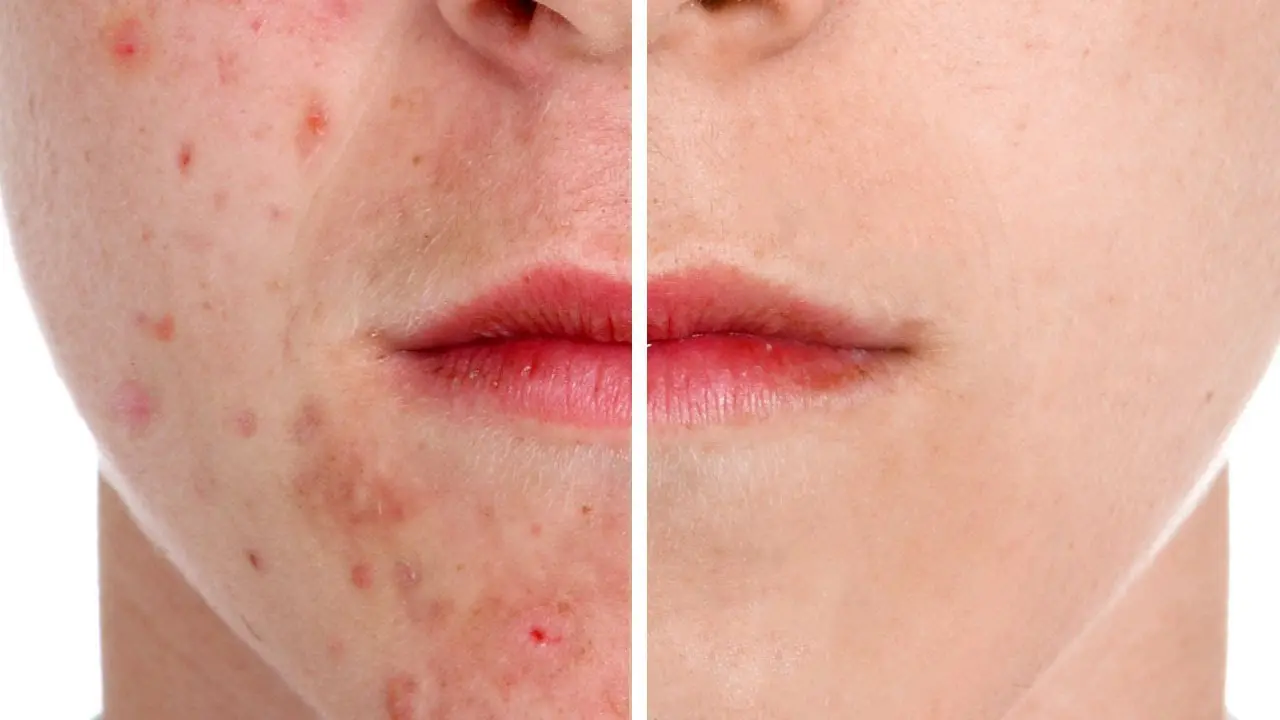 Buat Sendiri Masker Wajahmu Agar Terbebas dari Jerawat