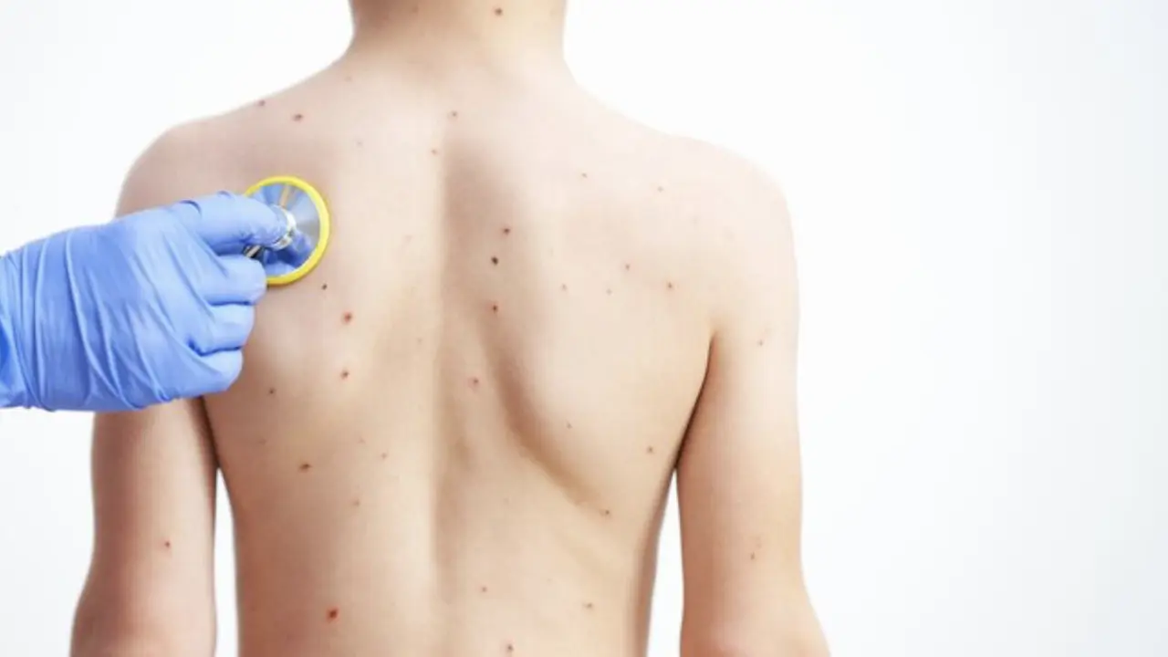Waspada Monkeypox! Begini Cara Mencegahnya Agar Tetap Aman (photo by freepik.com)