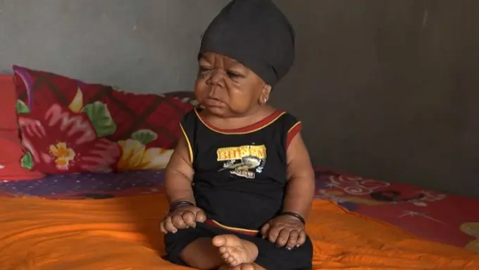 [Bintang] Mengidap Penyakit Langka, Pria Berusia 23 Tahun Miliki Fisik Seperti Bayi 1 Tahun