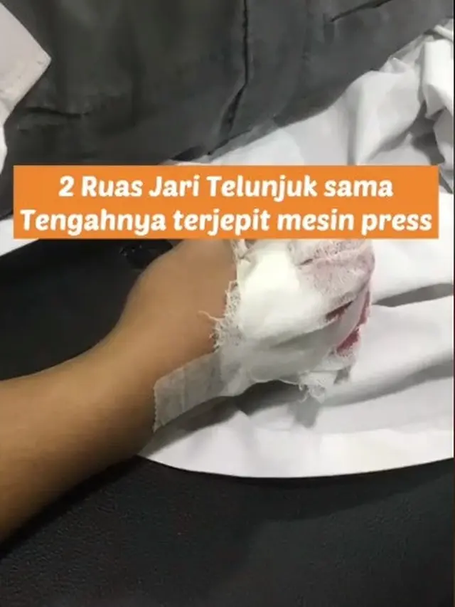 Alami Kecelakaan Hingga Diamputasi, Pria Ini Dibuatkan Jari Prostetik Oleh Teman