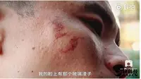 Wajah pria ini terluka karena ledakan iPhone 7 (Sumber: Tech Viral)