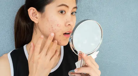 Kandungan Skincare Untuk Menyembuhkan Jerawat Pustula Beauty Fimela Com