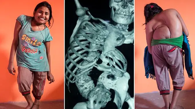 Risiko Kematian, Penderita Skoliosis Ini Terima Tawaran Operasi