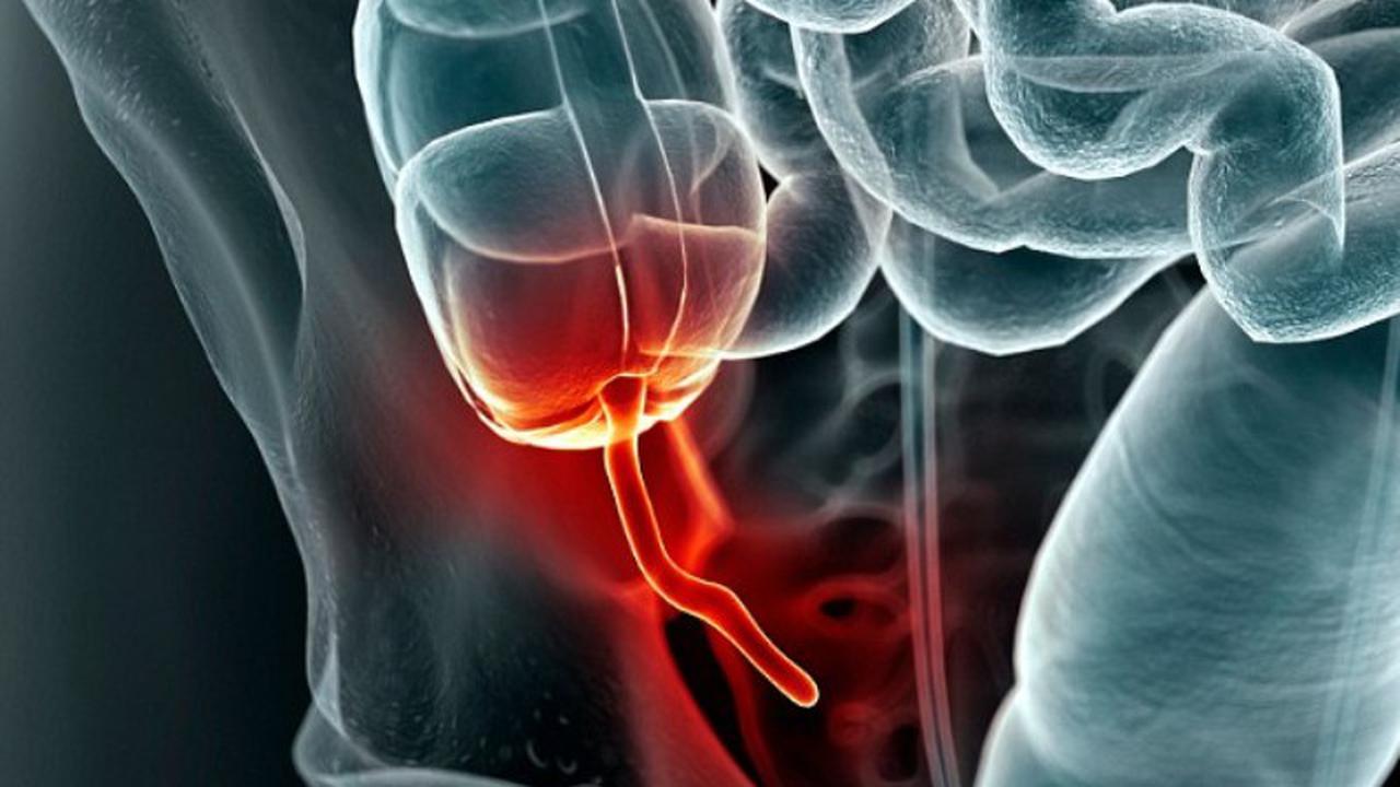 Dikira Usus Buntu, Ternyata Ada Kondom Menyangkut di Perut