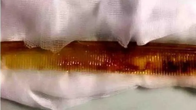 News Flash: Sisir Sepanjang 20 Cm Menyangkut di Tenggorokan  